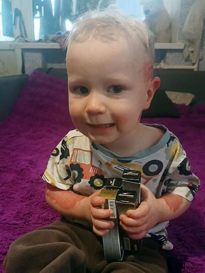 Мирон Брехер: перші кроки відновлення після важких опіків